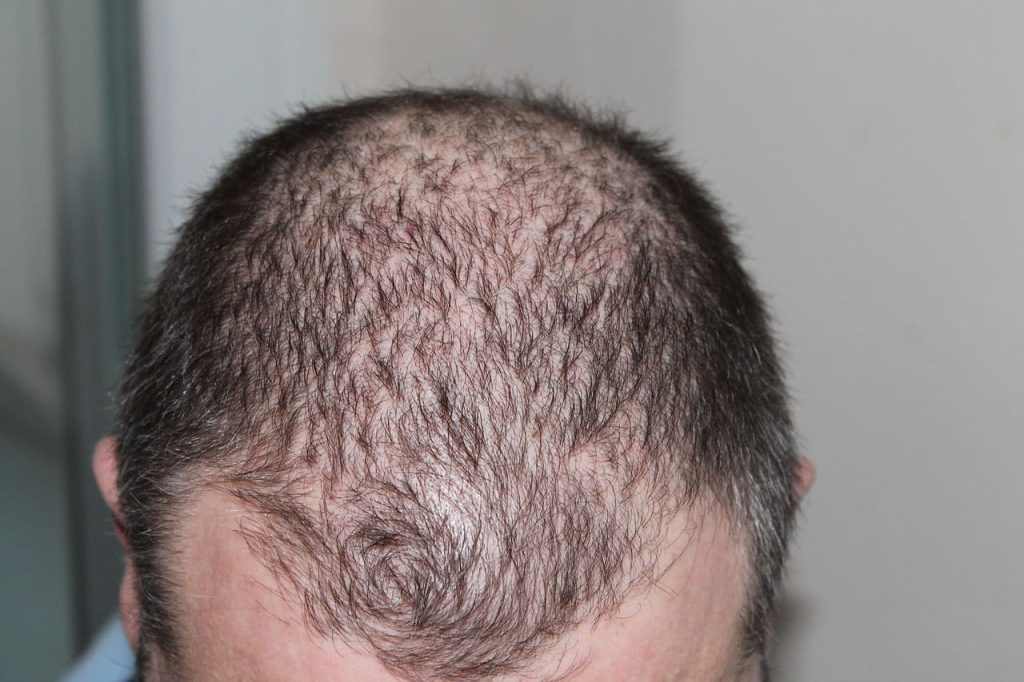 Read more about the article Tips On Supporting Your Husband Through Hair Loss